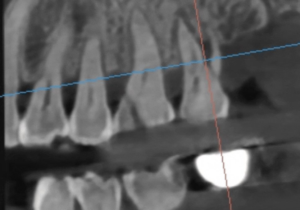 어금니 금 감, 치아 살릴 수 있는 기준은 바로 관련 이미지 7