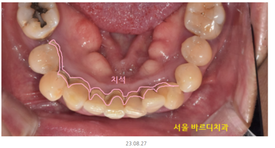 잇몸 주저앉음 발치하게 되는 제일 큰 원인이기에 잇몸치료 과정 공개 관련 이미지 4