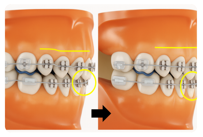 Blue Bite Blocks for Orthodontic Treatment: Everything You Need to Know, Organized image 4