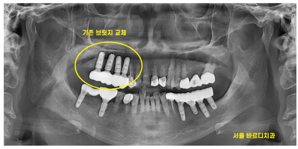 풍산동 치과 임플란트 시술후 통증 부작용은 아닐까? 관련 이미지 8