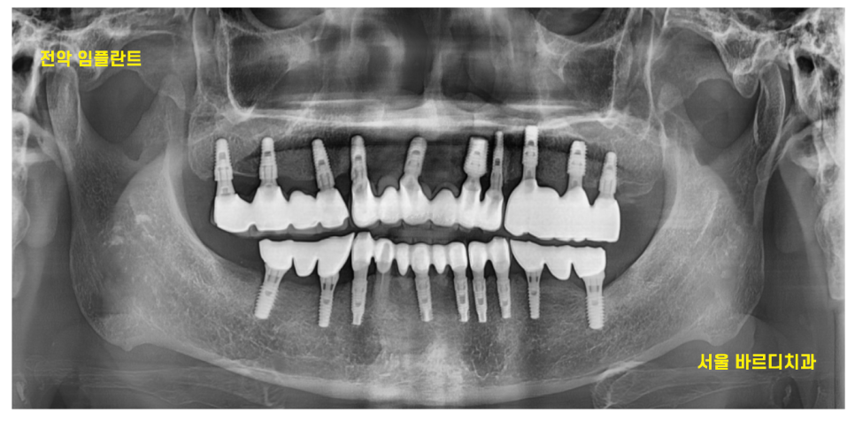 둔촌동 치과 임플란트 평균 수명 이것이 진짜 진실입니다 관련 이미지 5