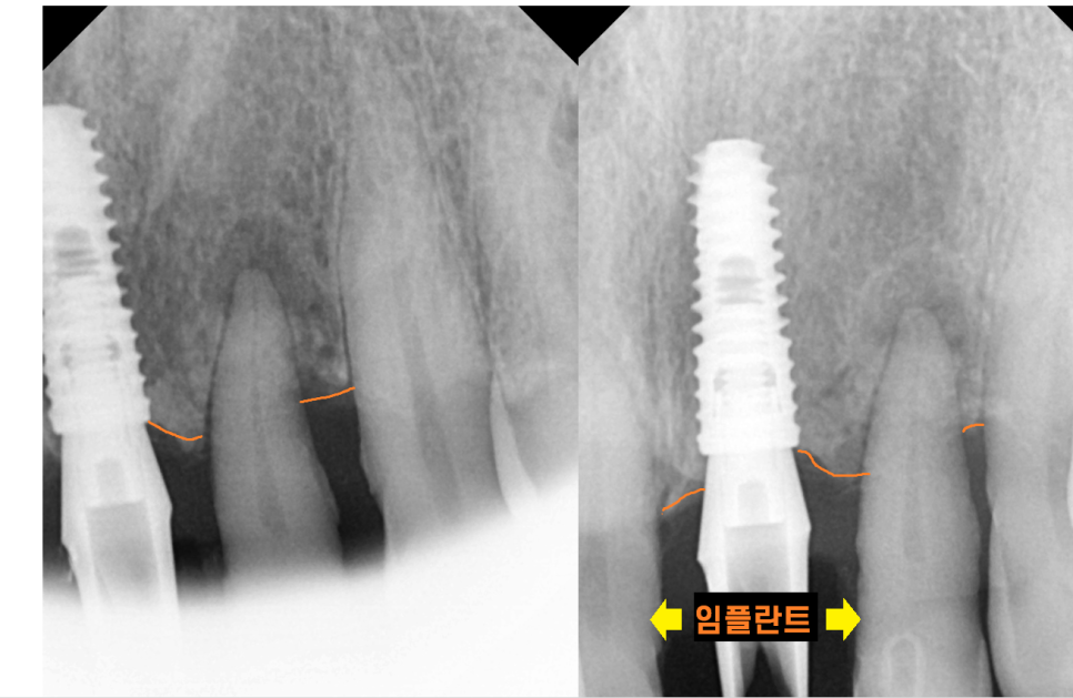상일동역 치과 윗니 앞니 흔들림 임플란트로 심미까지 잡았습니다. 관련 이미지 6