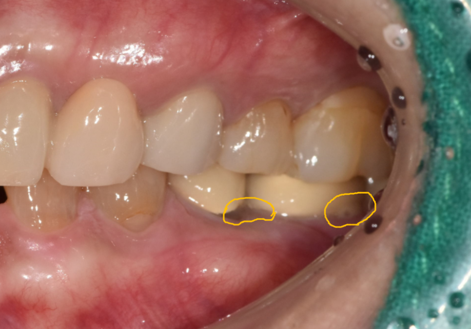 애써 심어둔 임플란트, 교체해야 된다구요? 냄새가 난다면 확인해보세요. 관련 이미지 6