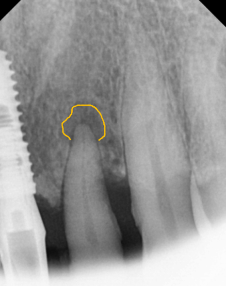 고덕동 임플란트, 튀어나온 앞니, 비용은 줄이고 자연스럽게 개선한 실제 사례 관련 이미지 3