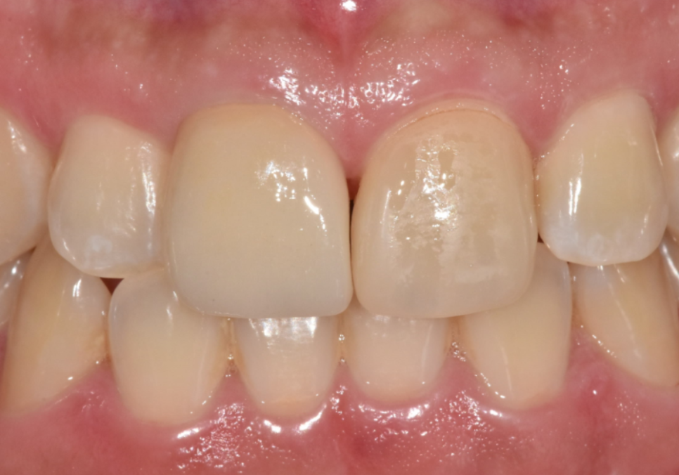 천호 라미네이트 파절 탈락, 줄이려면 치과 선택이 중요합니다. 관련 이미지 15