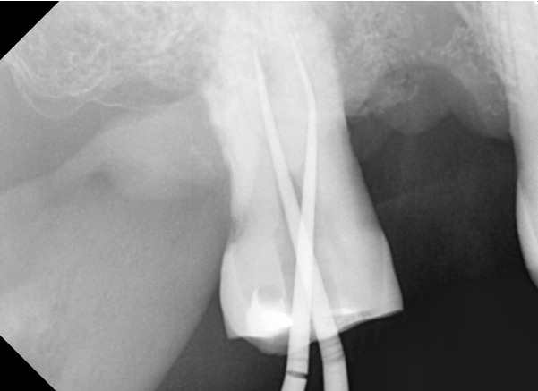서울바르디치과 무절개 네비게이션 임플란트 치료증례 #8 관련 이미지 4