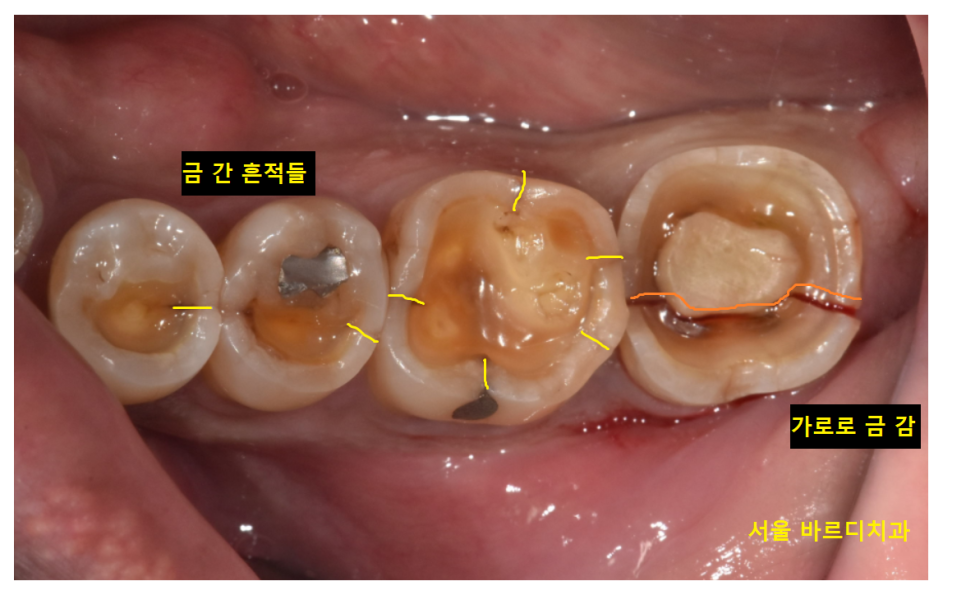 어금니 금감 발치 후 임플란트 풍산동 치과에서 진행했습니다. 관련 이미지 6