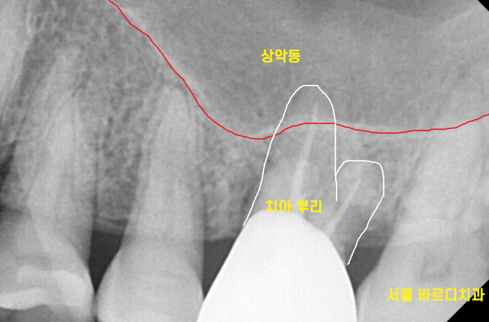 치아 쪼개짐으로 상악동 거상술 동반한 임플란트 수술 관련 이미지 6