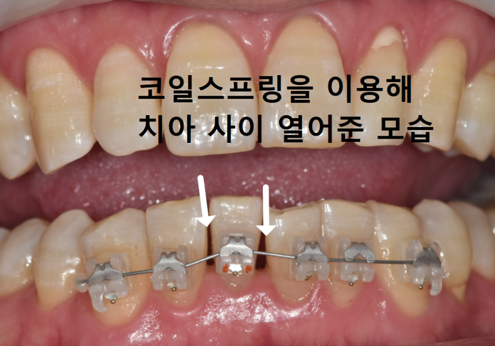 명일역 앞니 부분 교정, 치아 하나만 삐뚤어져 보인다면? 굳이 전체 교정할 필요 없습니다. 관련 이미지 8