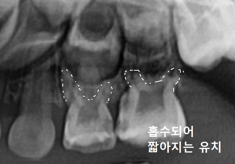 흔들리는 성인 잔존 유치, 50년 만에 송곳니 임플란트 하게 된 사연 관련 이미지 3