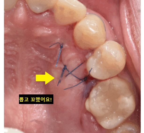 덕풍동 치과 교정 치료 위해 숨어있는 매복치 수술 발치 문제없습니다 관련 이미지 1