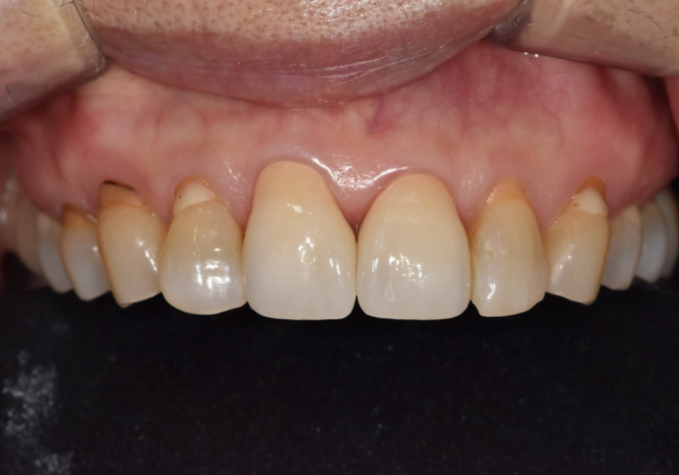 대문니 파절, 앞니에 금이 쩍 갈라졌다면? 딱딱한 음식을 조심해야 하는 이유 관련 이미지 15