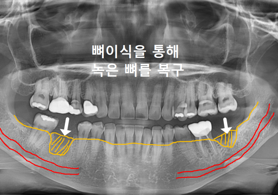 고덕역 임플란트, 뼈이식 꼭 해야 할까? 필수 상황 vs 제외 상황 총정리 관련 이미지 11