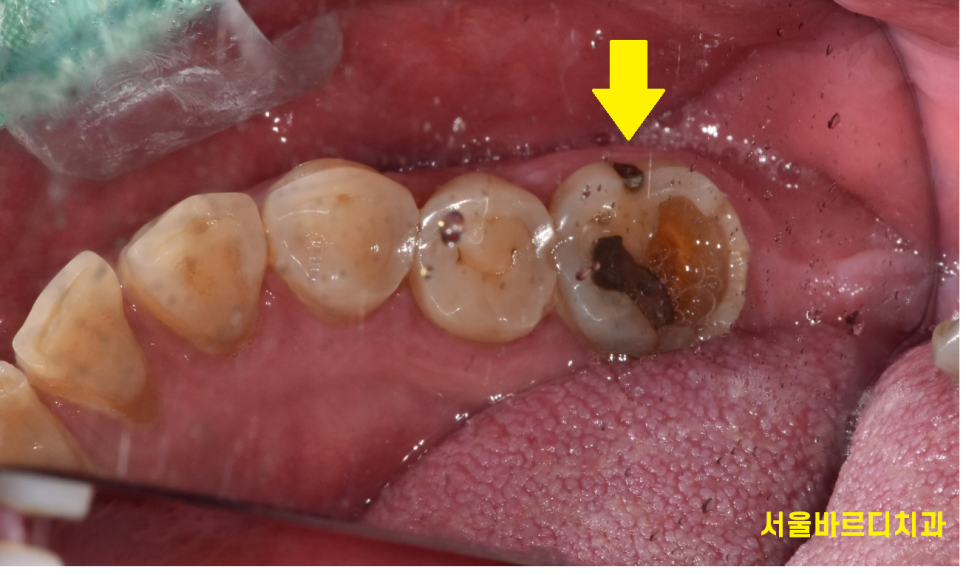 신경치료 후 통증 치아 뿌리 금으로 발치 후 강일역 임플란트 관련 이미지 2