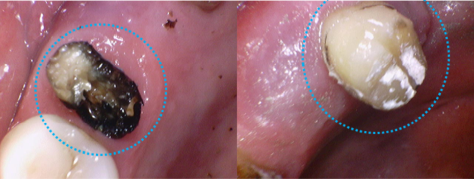 고덕동치과 서울바르디치과 전치부 및 구치부 임플란트 치료증례 #9 관련 이미지 16