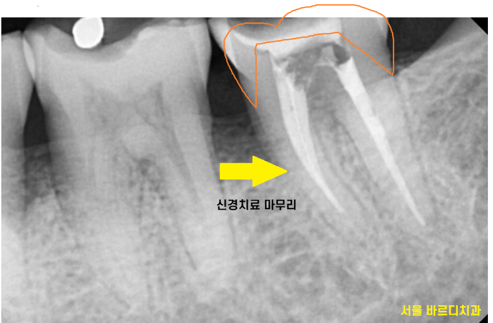 망월동 치과 신경치료 후 보철 꼭 씌워야 하나요?? 관련 이미지 5