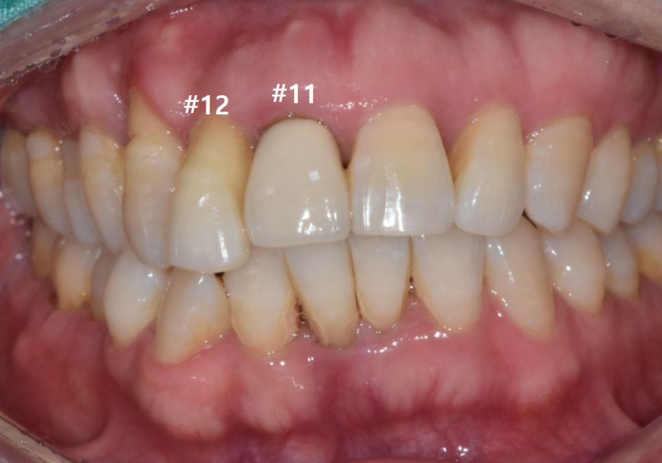 앞니 임플란트, 원내 기공소의 중요성을 아시나요? 관련 이미지 4