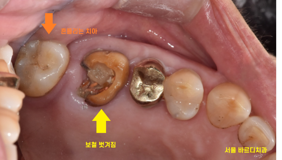 고덕동 치과 임플란트 거부감이 있었지만 네비게이션 수술법으로 해결했습니다. 관련 이미지 4