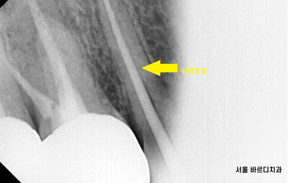 초이동 치과 치아 실금으로 조각나 신경치료까지 진행했습니다. 관련 이미지 7
