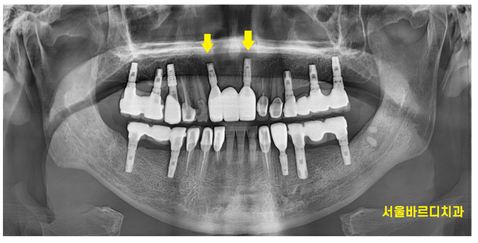 상일동역 치과 부러진 앞니 임플란트로 복구하기 프로젝트 관련 이미지 9