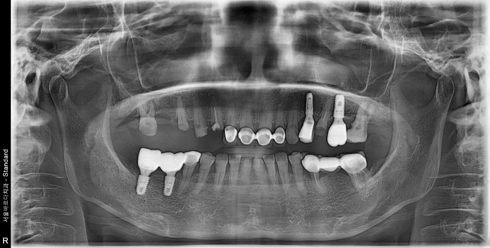A Case of a 69-Year-Old Who Underwent Immediate Implant Placement After Extraction Due to Tooth Decay in Godeok-dong image 1