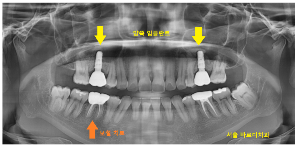 풍산동 치과 임플란트 양쪽 치료 가능한가요? 관련 이미지 13