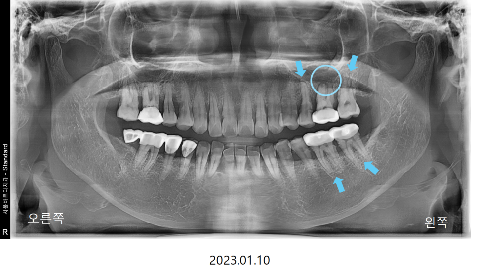 고덕동치과 서울바르디치과 무절개 네비게이션 임플란트 치료증례 #2 관련 이미지 1