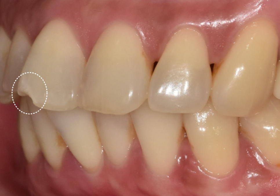 깨진 앞니 심미 치료, 라미네이트 vs 지르코니아 어떤 선택이 더 나을까? 관련 이미지 4