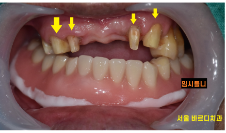 외국인 치과 진료 하악 전체 임플란트 7개 심어 12개 치아 만들기 관련 이미지 9