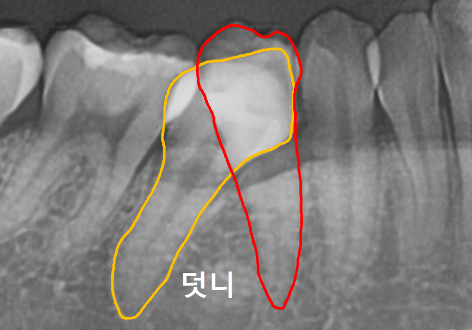 어금니 덧니 때문에 임플란트 해야 한다고요? 방치하면 안 되는 이유 관련 이미지 3