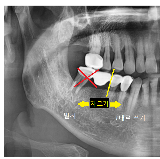 오래된 브릿지 보철 제거 후 고덕역 임플란트 교체 케이스 관련 이미지 5