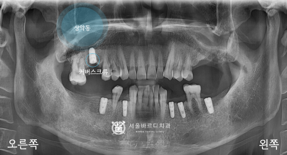 고덕동치과 서울바르디치과 무절개 네비게이션 임플란트 치료증례 #1 관련 이미지 11