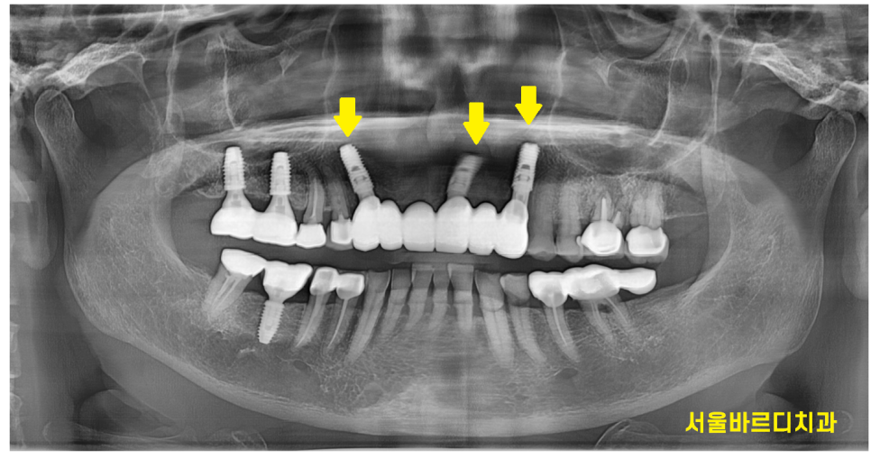 상일동 치과 충치로 인한 앞니 브릿지 파절 재건해보았습니다. 관련 이미지 8