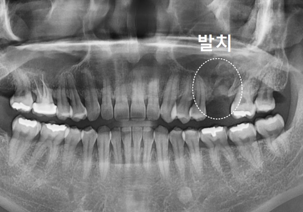 Sinusitis Caused by Teeth: Why Do You Tell Me to Go to the Dentist When My Nose Hurts? image 11