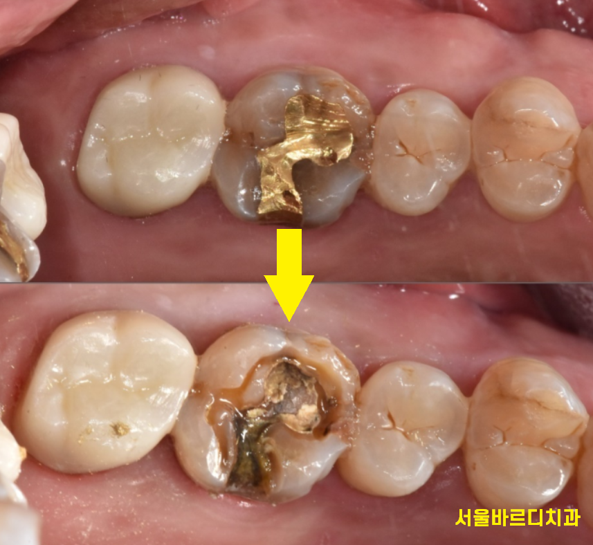 풍산동 치과 골드 인레이 치료했던 치아가 또 충치가 생김. 관련 이미지 6