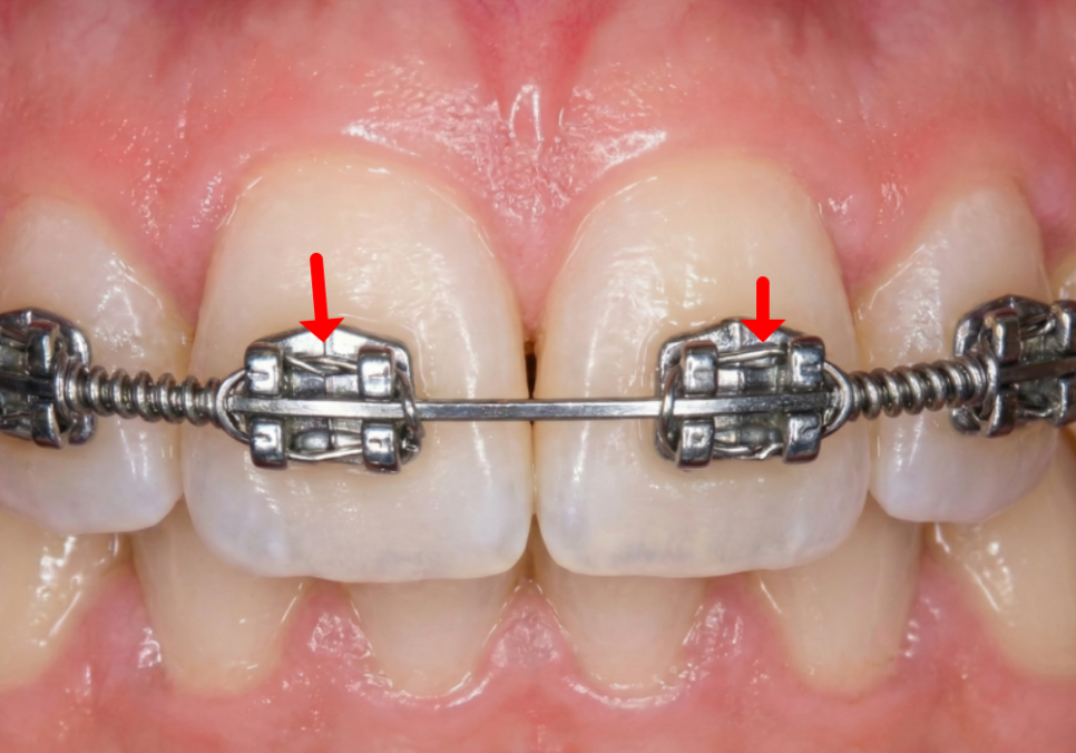 명일역 앞니 부분 교정, 치아 하나만 삐뚤어져 보인다면? 굳이 전체 교정할 필요 없습니다. 관련 이미지 4