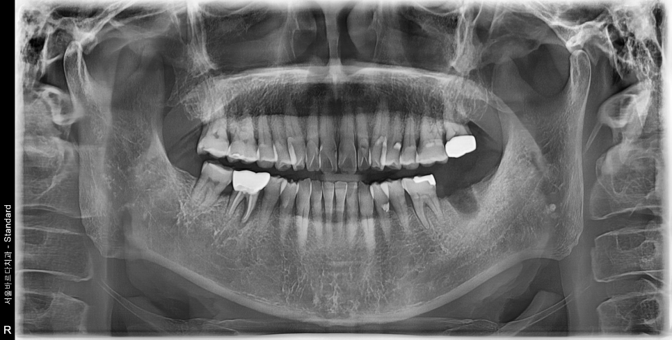 바르디 임플란트는 바르게 심지만, 빠르게 씹습니다. 그간의 경험을 바탕으로요. 관련 이미지 6