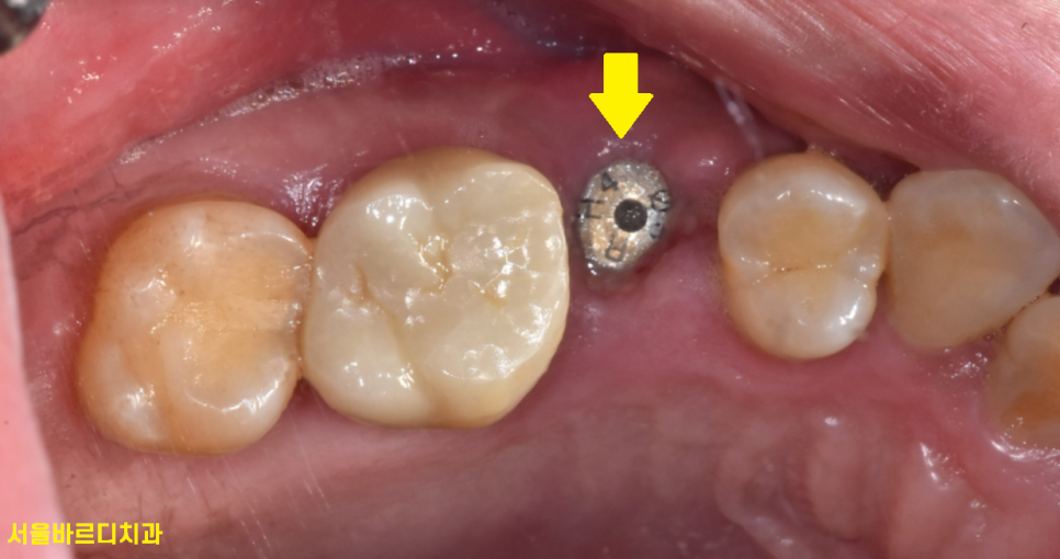 풍산동 치과 어금니 쪼개짐 임플란트를 해야할 때는? 관련 이미지 9