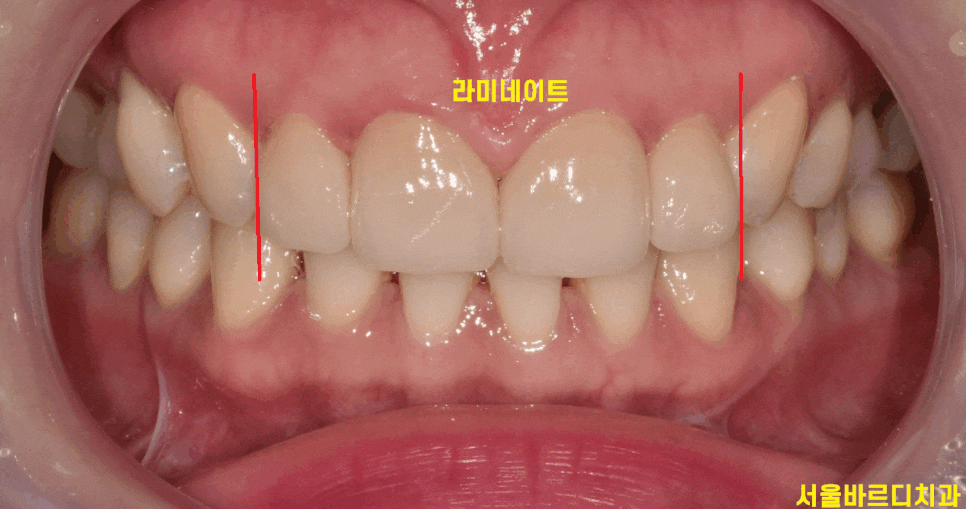 왜소치 라미네이트 작은 치아 콤플렉스 말끔하게 극복해요!! 관련 이미지 1
