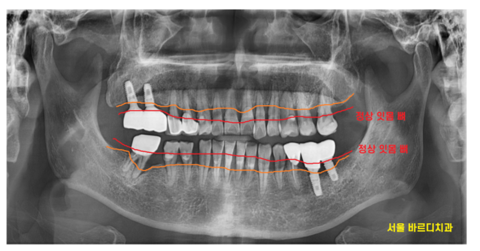 상일동 치과 치아 하나 빠지면 시작 됐을 수 있습니다 관련 이미지 2