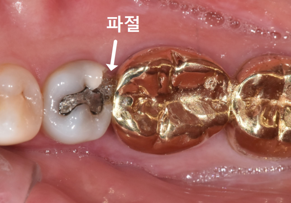 아말감 파절, 조금 깨졌을 뿐인데, 2차 충치로 치아 절반이 깨진 사연 관련 이미지 4