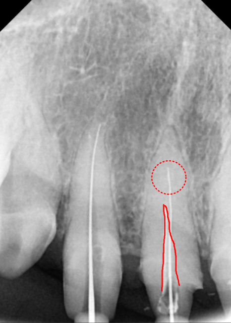 고덕동 심미 보철, 삐뚤어진 앞니, 교정 없이 바로잡은 비결 관련 이미지 7