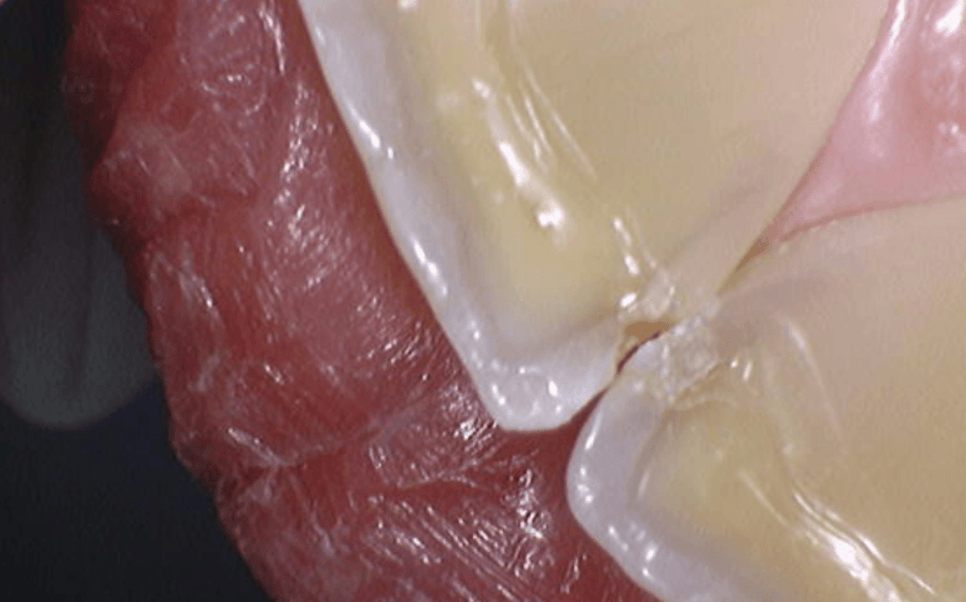 앞니 깨졌을 때, 치아 파절 실비 가능한가요? 관련 이미지 2