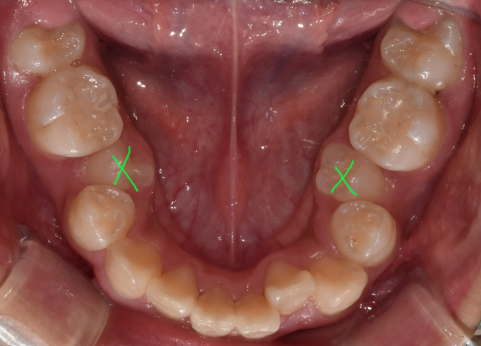 How to Correct a Canine Crowding Malocclusion: Extractions Are Necessary to Address Lip Protrusion image 7