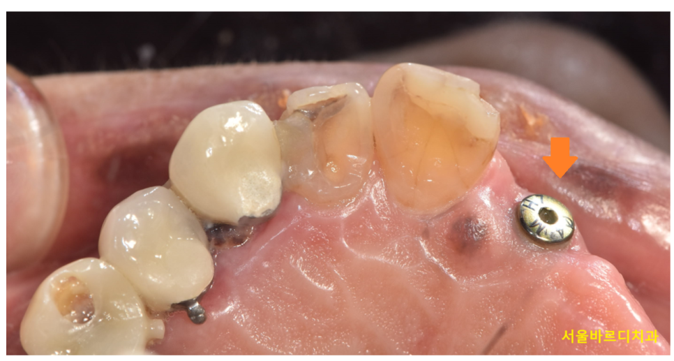 임플란트 수술 통증과 붓기 시기별 회복 과정 총정리! 관련 이미지 3