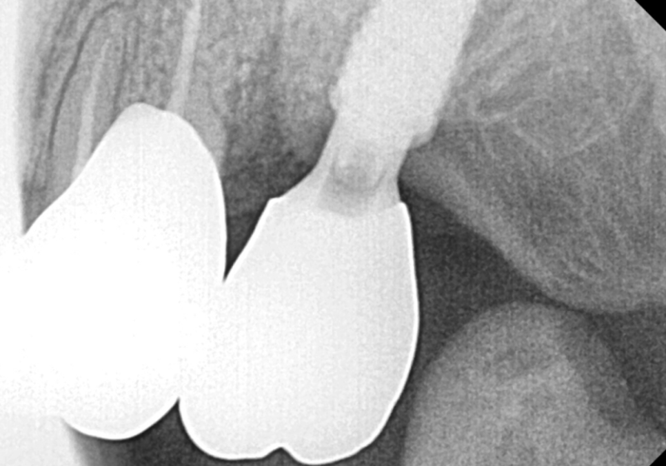 어금니 금 감, 치아 살릴 수 있는 기준은 바로 관련 이미지 13