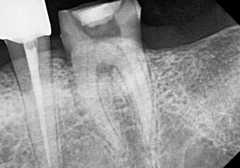 상일역 치과, 오래된 금니 빠짐, 같은 증상으로 내원했지만 전혀 다른 결과, 그 차이는? 관련 이미지 14