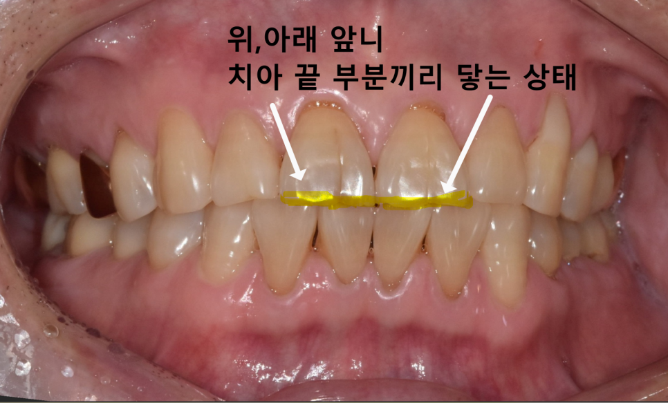 앞니 금 갔을 때, 방치하면 안 되는 진짜 이유 <파절 치료 사례> 관련 이미지 4