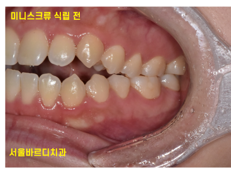 교정중 미니스크류 필수일까? 투명교정도 때로는 필요하다 관련 이미지 4