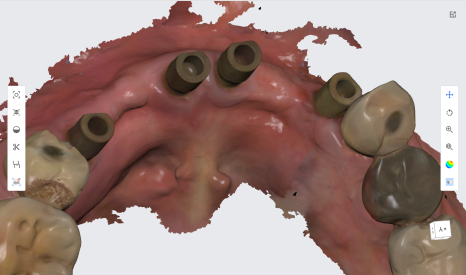 네비게이션 임플란트가 왜 좋다고 그러는거죠? (feat.13가지 장점) 관련 이미지 17